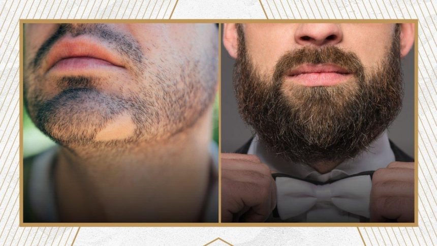 How to Prepare for Beard Hair Transplant Avoid These Common Mistakes.
