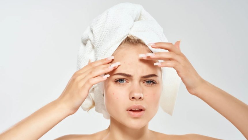 Ready to Banish Blemishes? Here's The 2024 Guide to Effective Acne Spot Treatments