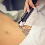 What to Expect During the Tattoo Removal Process