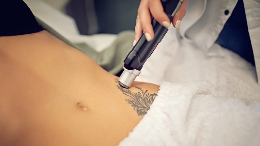 What to Expect During the Tattoo Removal Process