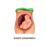 Here's Everything You Need to Know About Breech Presentation