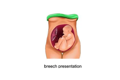 Here's Everything You Need to Know About Breech Presentation