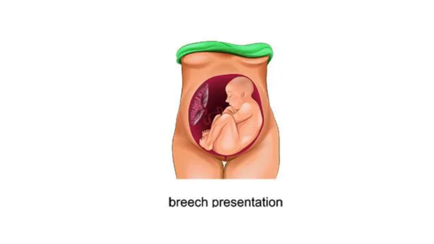 Here's Everything You Need to Know About Breech Presentation