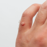 How to Identify Warts on Skin and Remove Them