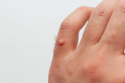 How to Identify Warts on Skin and Remove Them