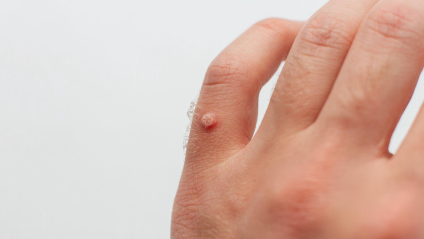 How to Identify Warts on Skin and Remove Them