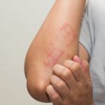 Your Guide to Scabies Treatment Medications, Remedies, and Prevention Tips