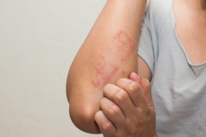 Your Guide to Scabies Treatment Medications, Remedies, and Prevention Tips