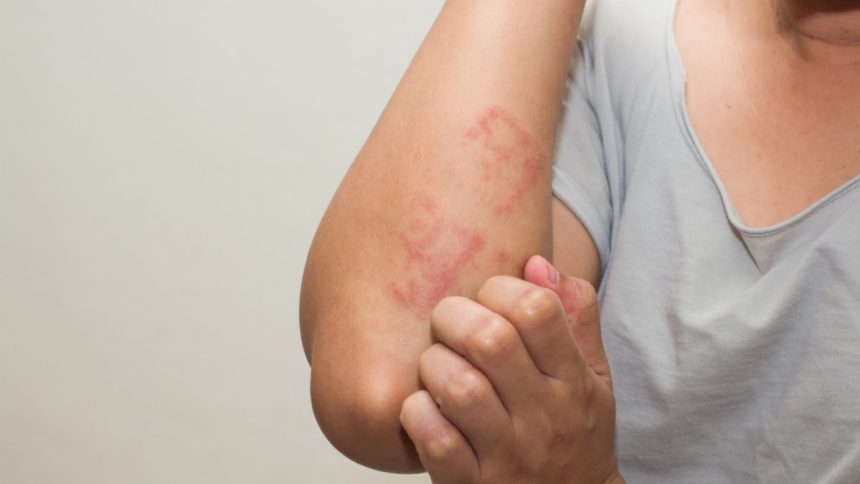 Your Guide to Scabies Treatment Medications, Remedies, and Prevention Tips