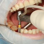 How to get a high-quality All-on-4 implant in Guadalajara, Mexico