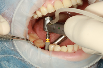 How to get a high-quality All-on-4 implant in Guadalajara, Mexico