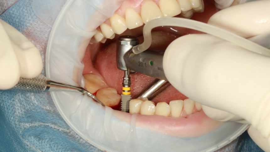 How to get a high-quality All-on-4 implant in Guadalajara, Mexico