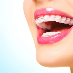 Essential Tips for Keeping Ceramic Braces Clean and Stain-Free