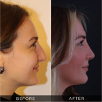 What Makes a Surgeon the Best? A Guide to Rhinoplasty Excellence in Turkey