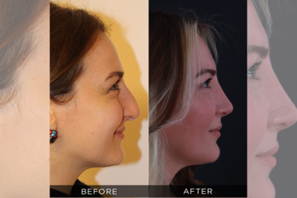 What Makes a Surgeon the Best? A Guide to Rhinoplasty Excellence in Turkey