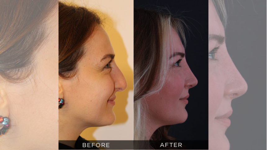 What Makes a Surgeon the Best? A Guide to Rhinoplasty Excellence in Turkey